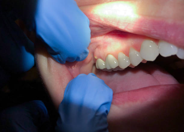 Best Emergency Treatment for Dental Infections or Abscesses in Dalhart, TX